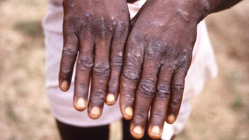 Congo's Monkeypox Problem