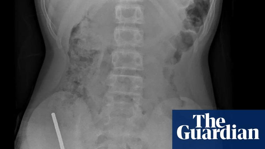 Teen Swallows Many Magnets, Requires Surgery for Intestine Issues
