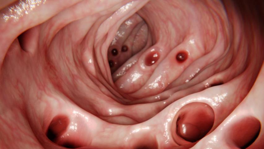 Tiny Gut Pouches: Common by 80, Mostly Harmless