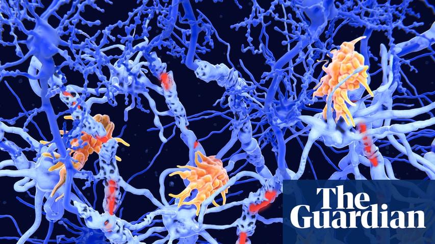 Surprise! Two Kinds of MS Found!